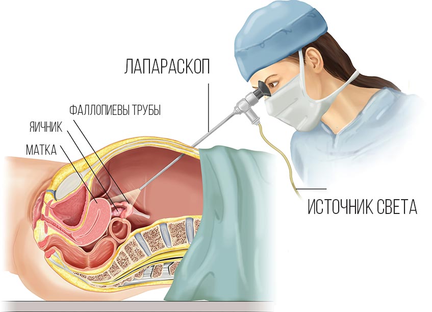 Удаление маточной трубы (тубэктомия)