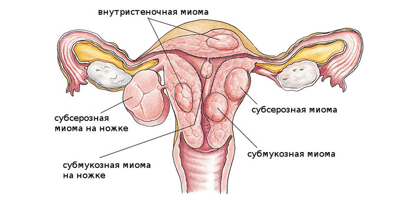Железисто-фиброзный полип эндометрия: лечение