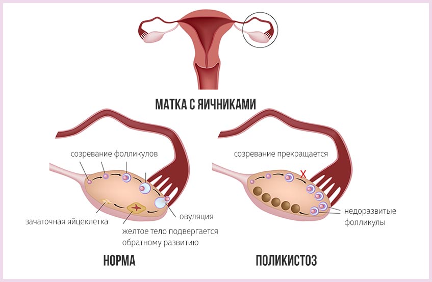 Овуляция при поликистозе. Синдром поликистозных яичников менструация. СПКЯ И противозачаточные. СПКЯ менструальный цикл.